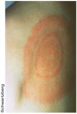 Bull eye’s rash